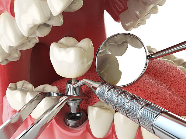 Best Emergency Tooth Extraction in Willow Creek, CA
